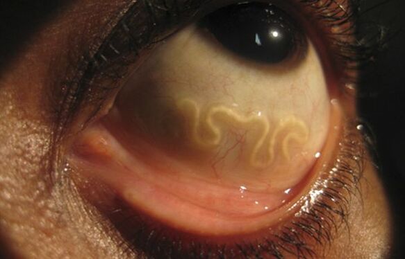 Loa Loa-worm leeft in het menselijk oog en veroorzaakt blindheid